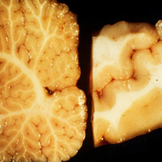 A side-by-side comparison of the cerebellar cortex and the neocortex.